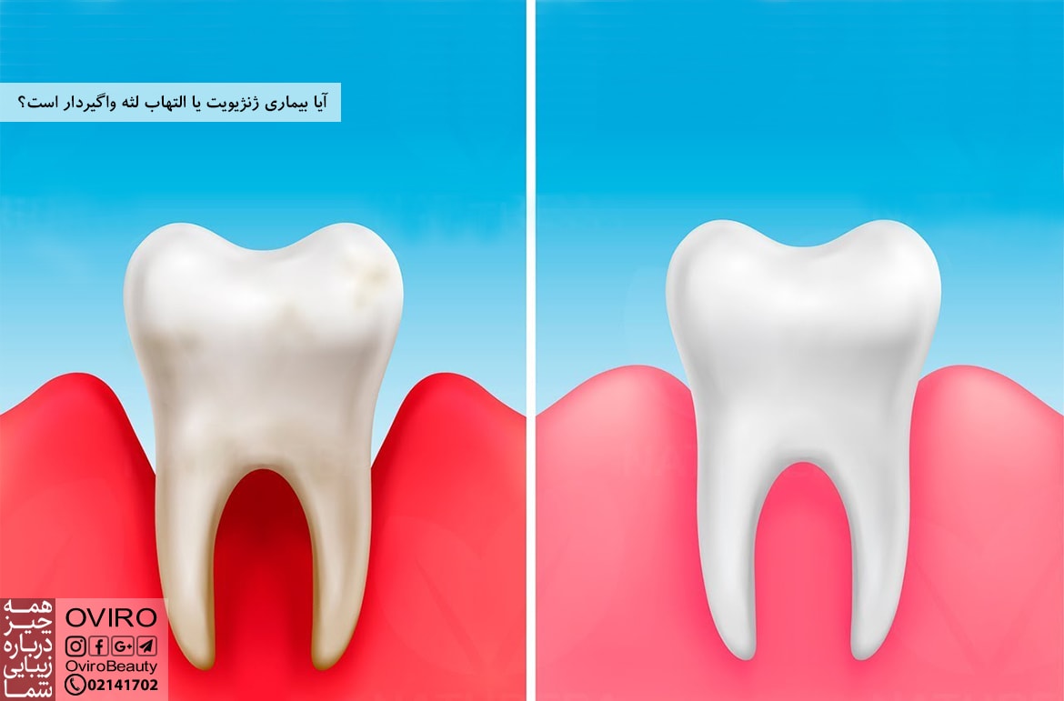 آیا بیماری ژنژیویت یا التهاب لثه واگیردار است؟