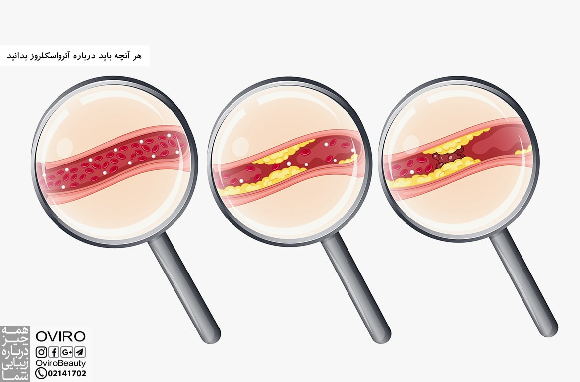 هر آنچه باید درباره آترواسكلروز بدانید