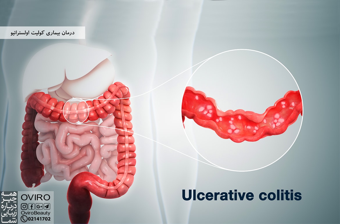 درمان بیماری کولیت اولستراتیو