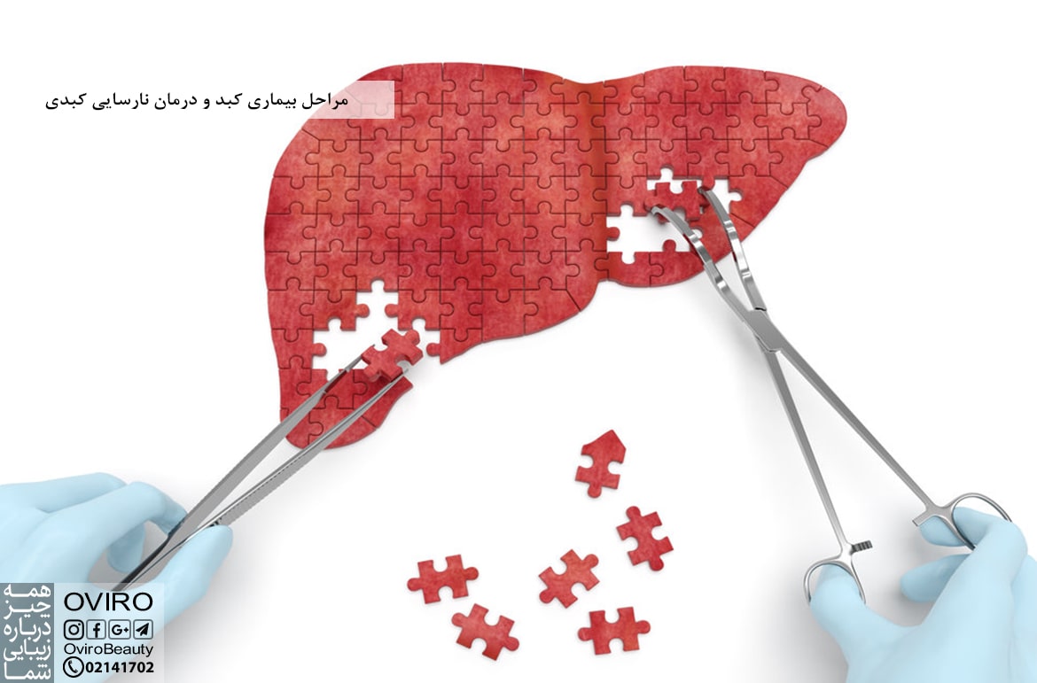 مراحل بیماری کبد و درمان نارسایی کبدی
