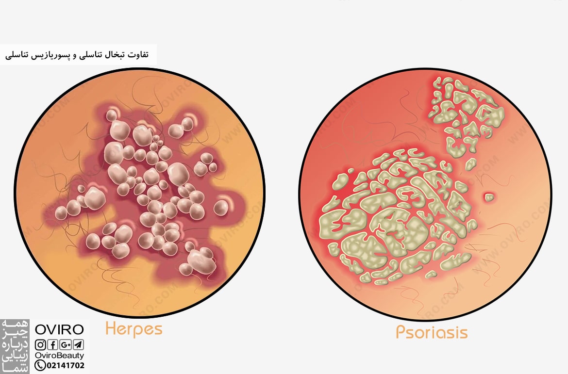 تفاوت تبخال تناسلی و پسوریازیس تناسلی