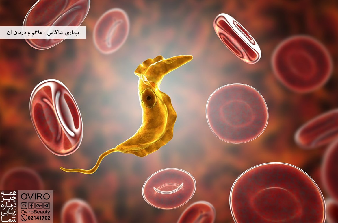 بیماری شاگاس : علائم و درمان آن