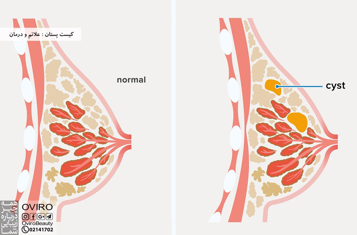 کیست پستان : علائم و درمان