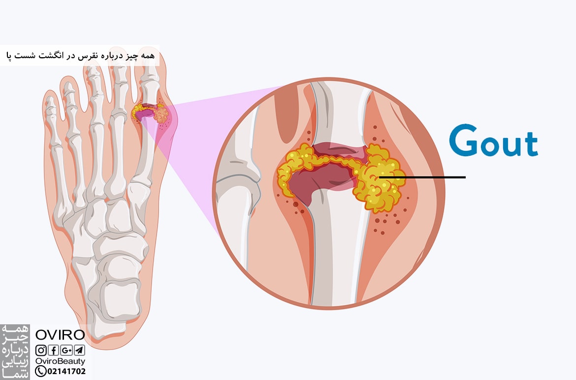 همه چیز درباره نقرس در انگشت شست پا