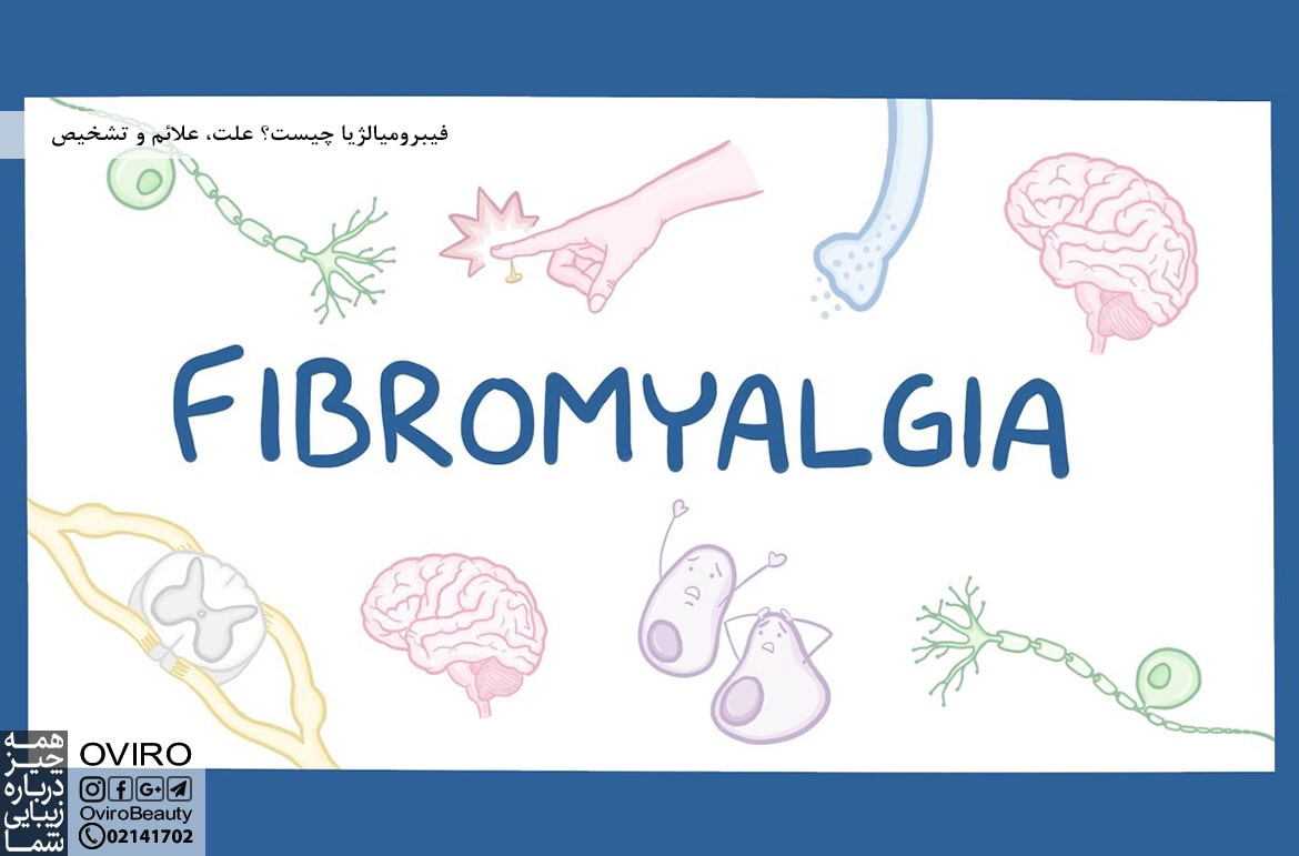 سندروم فیبرومیالژیا