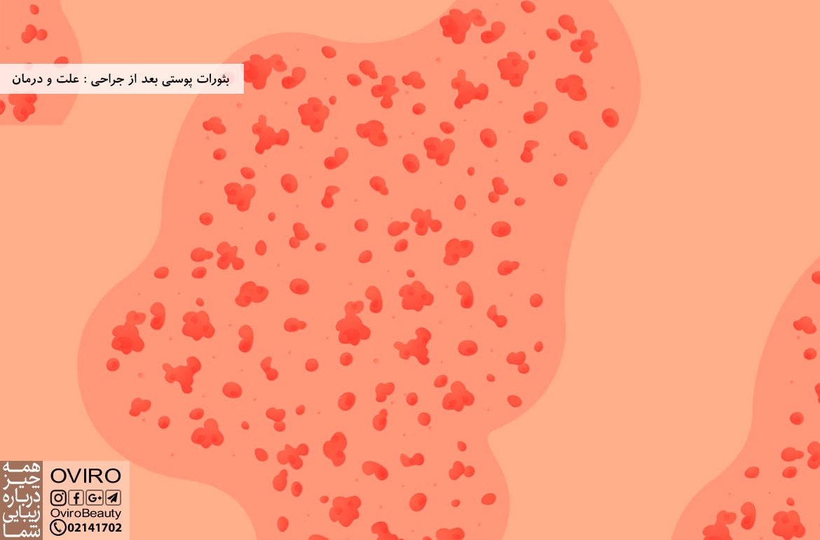 بثورات پوستی بعد از جراحی : علت و درمان