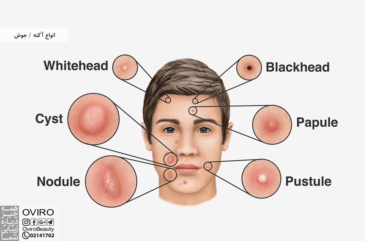 انواع آکنه / جوش