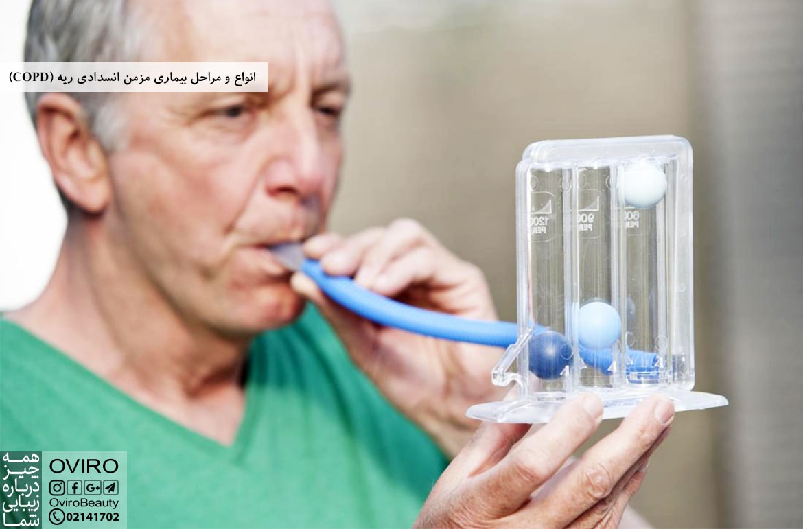 انواع و مراحل بیماری مزمن انسدادی ریه (COPD)