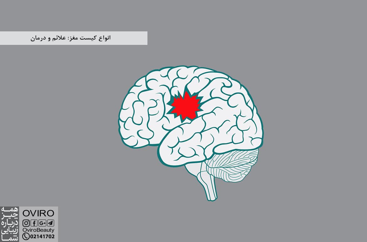 انواع کیست مغز: علائم و درمان