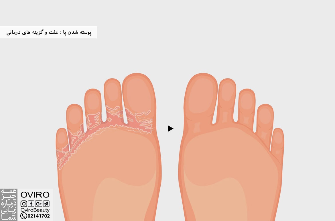 پوسته شدن پا : علت و گزینه های درمانی
