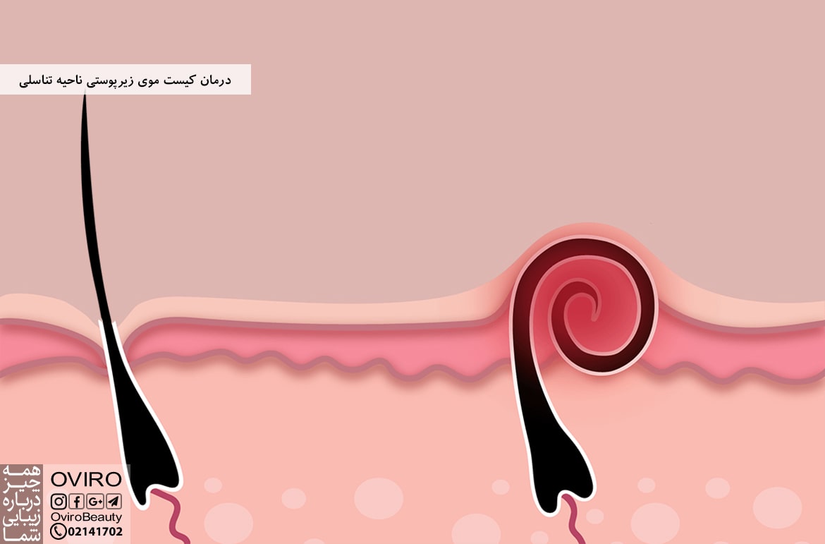 درمان کیست موی زیرپوستی ناحیه تناسلی