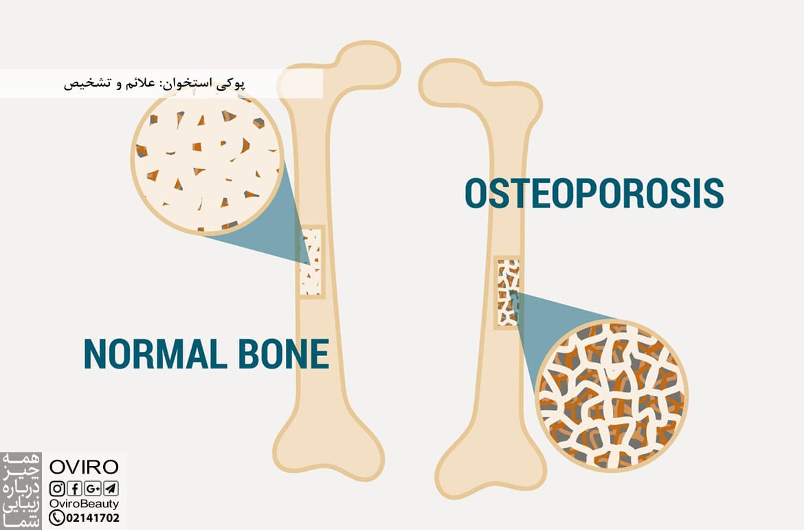 پوکی استخوان: علائم و تشخیص