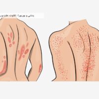 پتشی و پورپورا : تفاوت، علت و روش های درمان