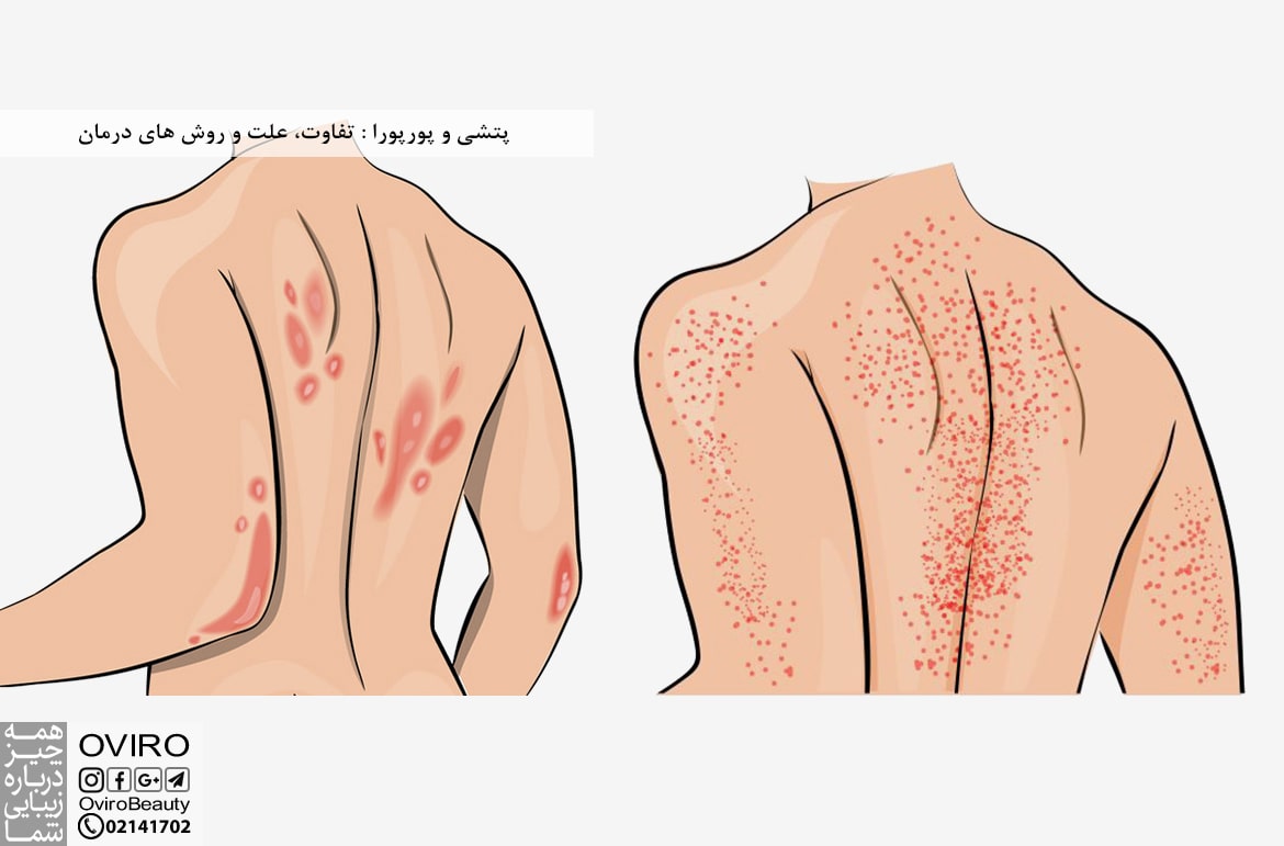 پتشی و پورپورا : تفاوت، علت و روش های درمان