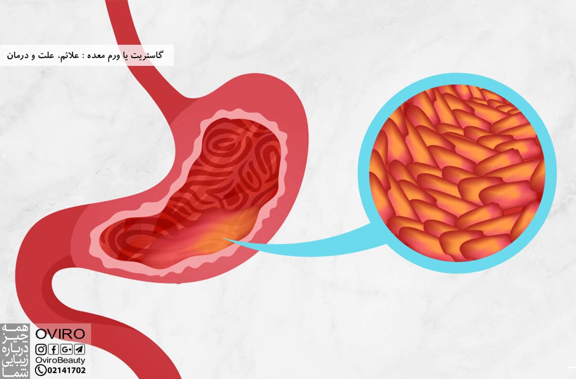 گاستریت یا ورم معده : علائم، علت و درمان