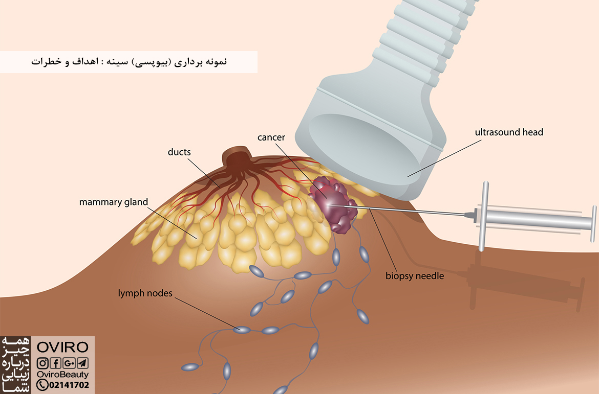 نمونه برداری (بیوپسی) سینه : اهداف و خطرات