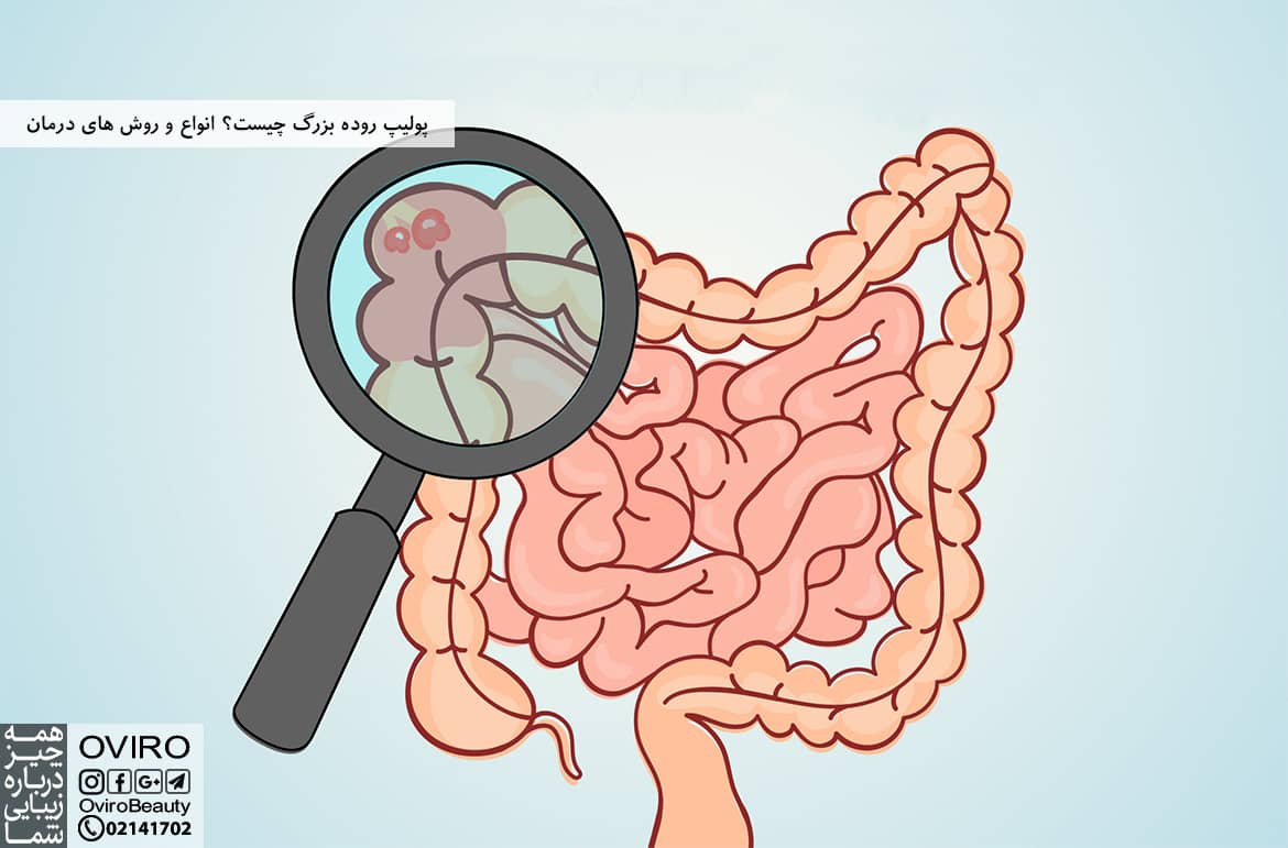 پولیپ روده بزرگ چیست؟ انواع و روش های درمان