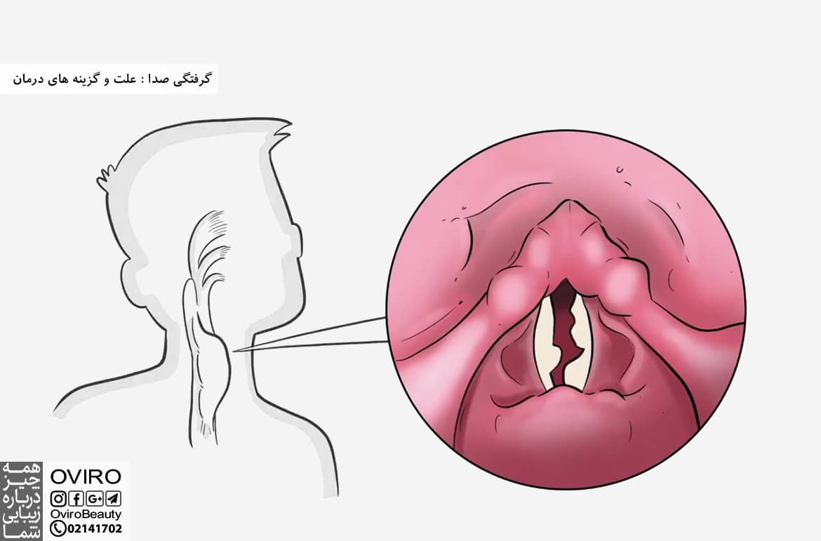 گرفتگی صدا : علت و گزینه های درمان