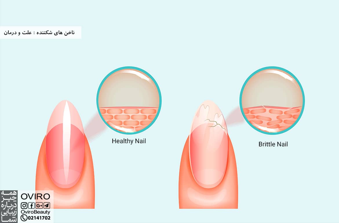 همه چیز در مورد ناخن های شکننده