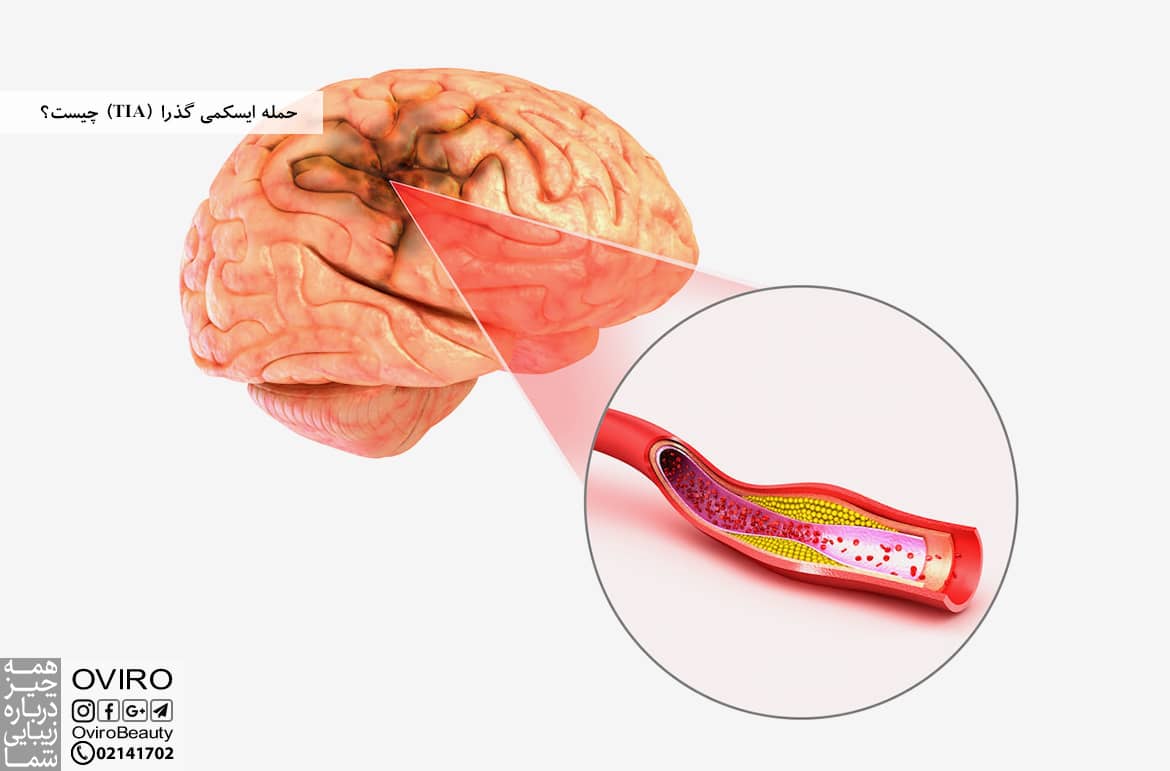 حمله ایسکمی گذرا (TIA) چیست؟