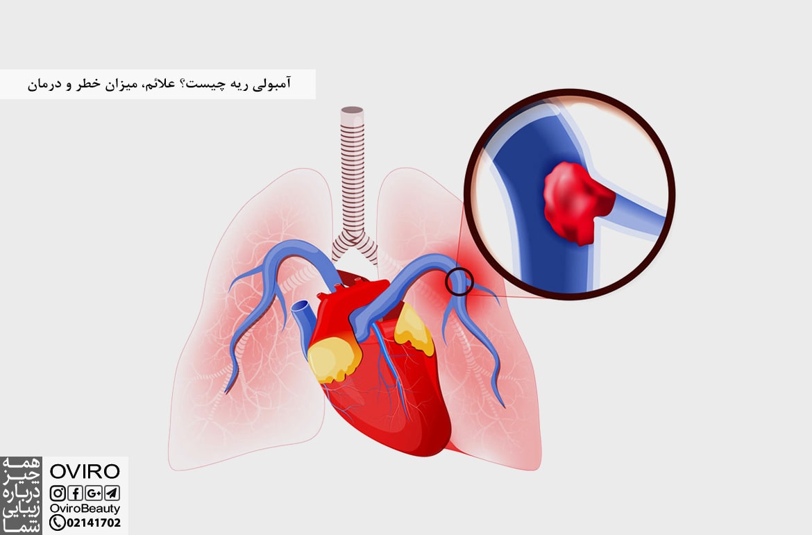 آمبولی ریه چیست؟ علائم، میزان خطر و درمان