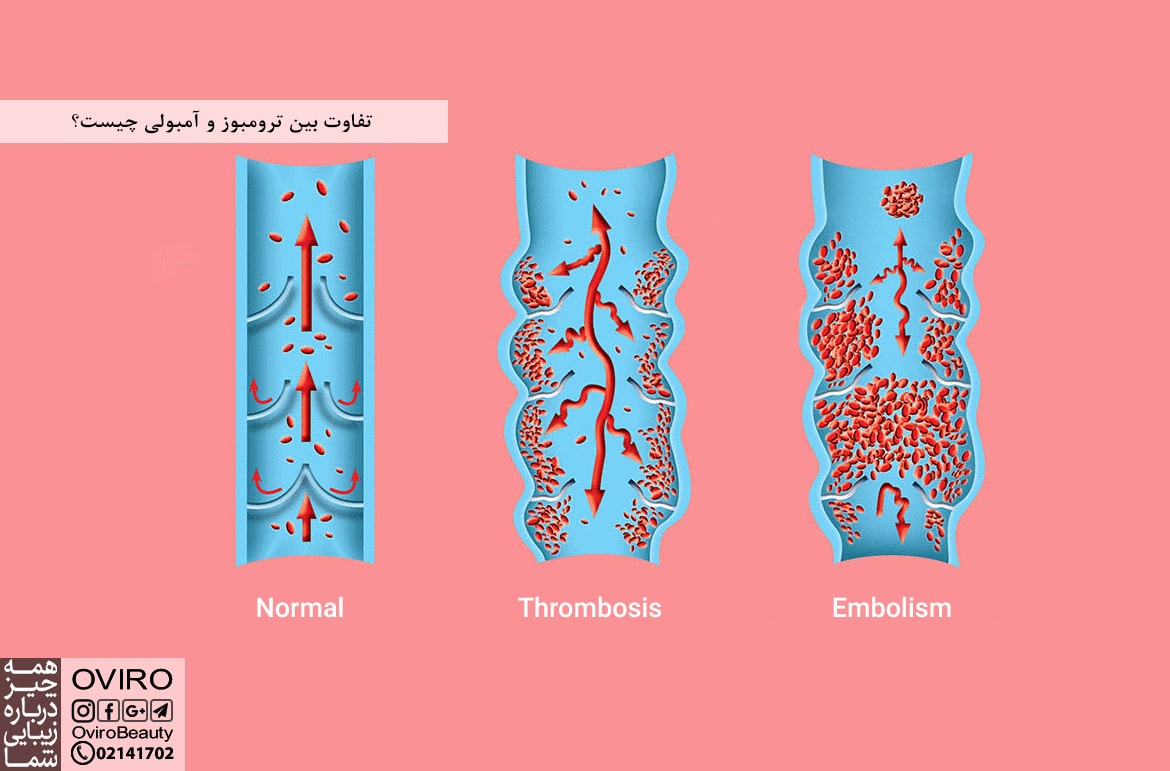 تفاوت بین ترومبوز و آمبولی چیست؟