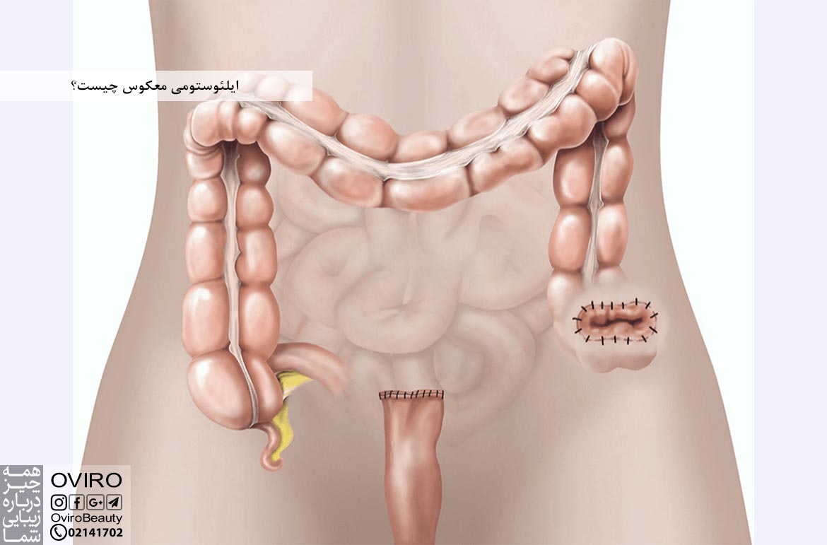 ایلئوستومی معکوس چیست؟