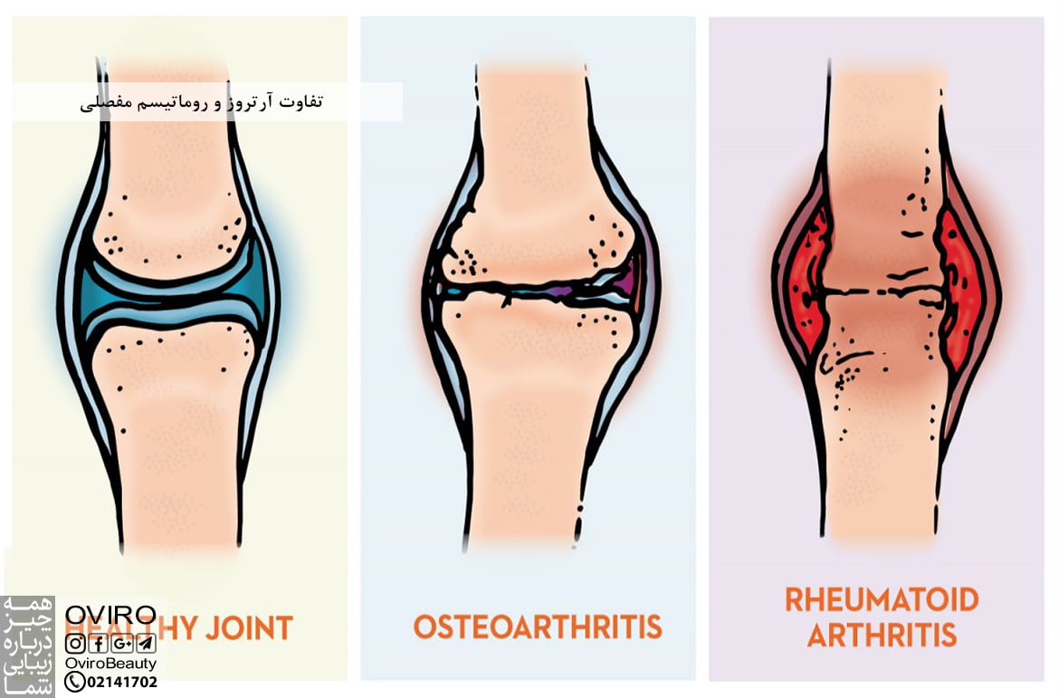 تفاوت آرتروز و روماتیسم مفصلی | فرق استئوآرتریت و آرتریت روماتوئید