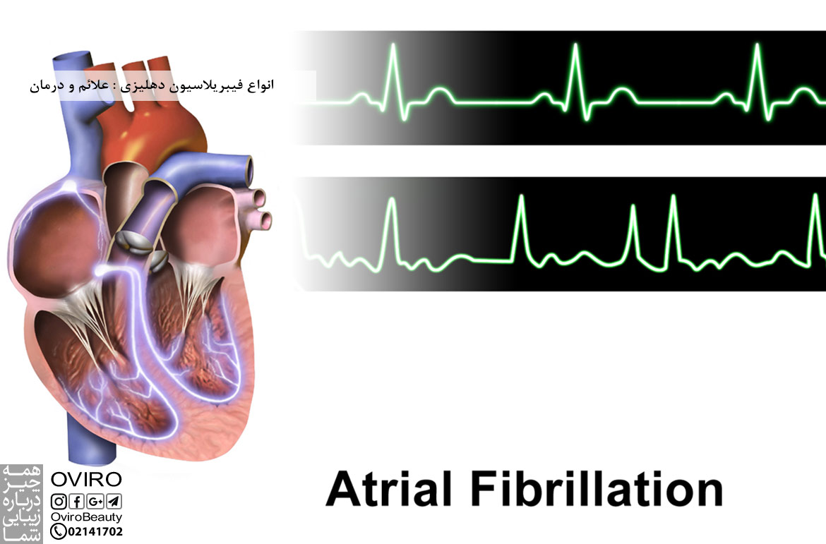 انواع فیبریلاسیون دهلیزی : علائم - درمان | بی نظمی ضربان قلب / آریتمی | اویرو مگ