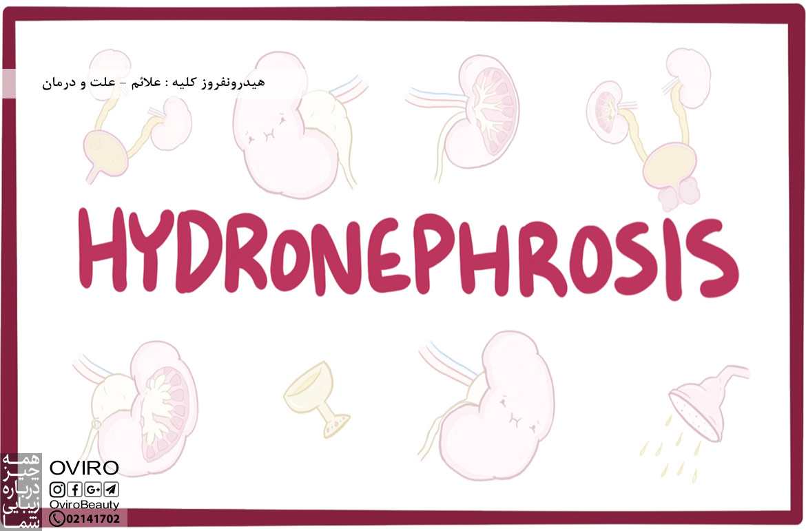 هیدرونفروز کلیه : علائم - علت - تشخیص و درمان در بزرگسالان - نوزادان و جنین  | ورم کلیه