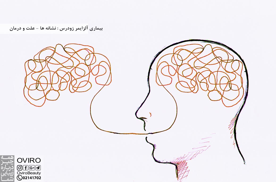 بیماری آلزایمر زودرس : نشانه ها - علت - تشخیص - درمان - چشم انداز | اویرو مگ