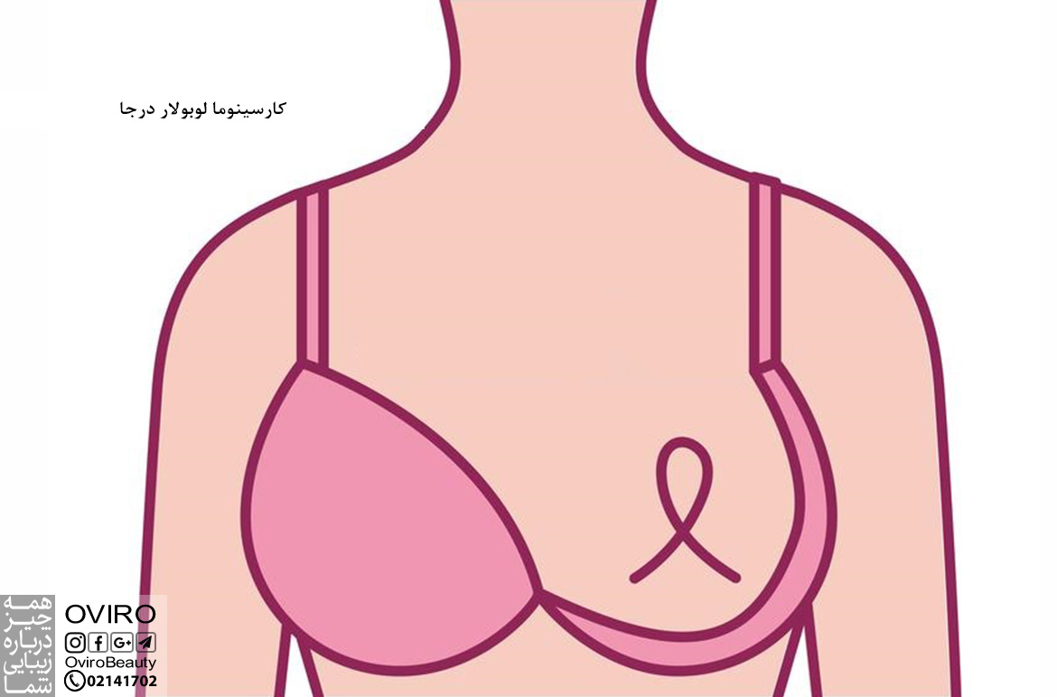 کارسینوما لوبولار درجا / سرطان لوبولار درجا : علت - علائم و درمان | سرطان غدد شیری پستان