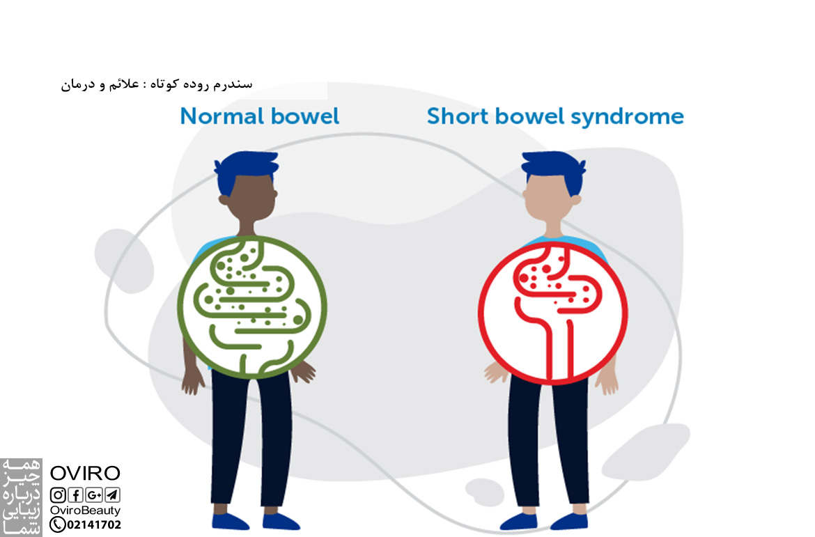 سندرم روده کوتاه : علائم و درمان و علت و عوارض در نوزادان و بزرگسالان