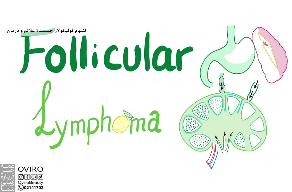 لنفوم فولیکولار چیست؟ انواع - علائم - علت - درمان - تشخیص - مرحله بندی - چشم انداز