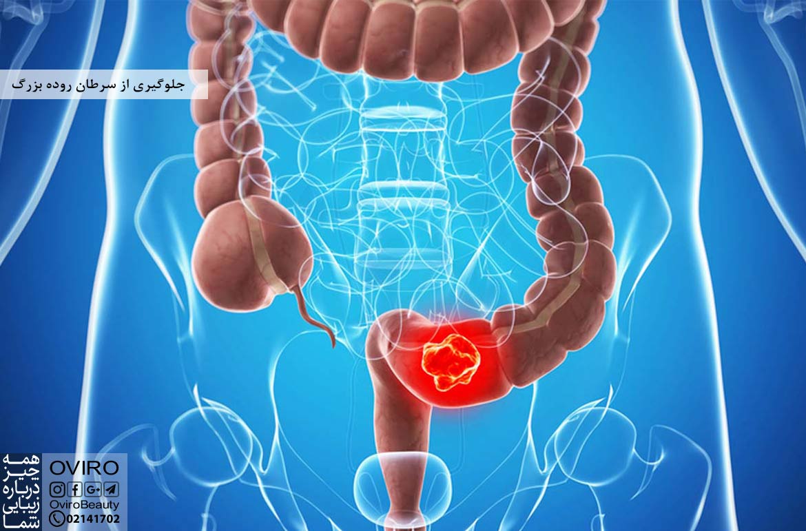 جلوگیری از سرطان روده بزرگ | کاهش خطر سرطان روده بزرگ | عوامل خطر سرطان روده