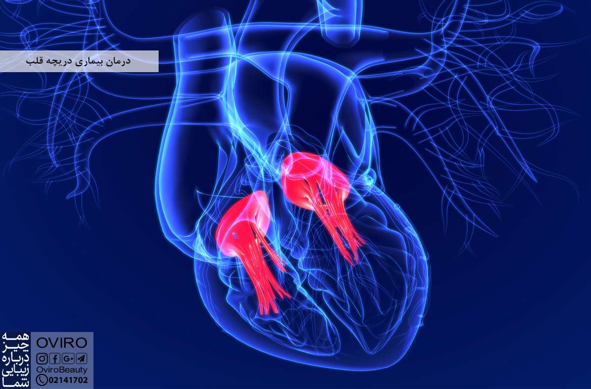 درمان بیماری دریچه قلب - انواع - علت - علائم - تشخیص | اختلالات مربوط به دریچه های قلب