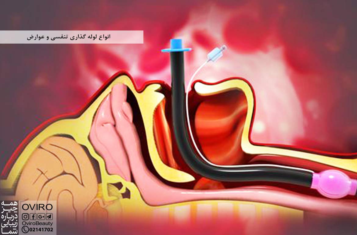 انواع لوله گذاری تنفسی و عوارض - نحوه انجام | علت لوله گذاری در گلو