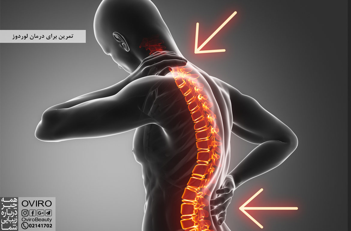 تمرین برای درمان لوردوز | علائم - علت - عوامل خطر - تشخیص لوردوز کمری و گردن