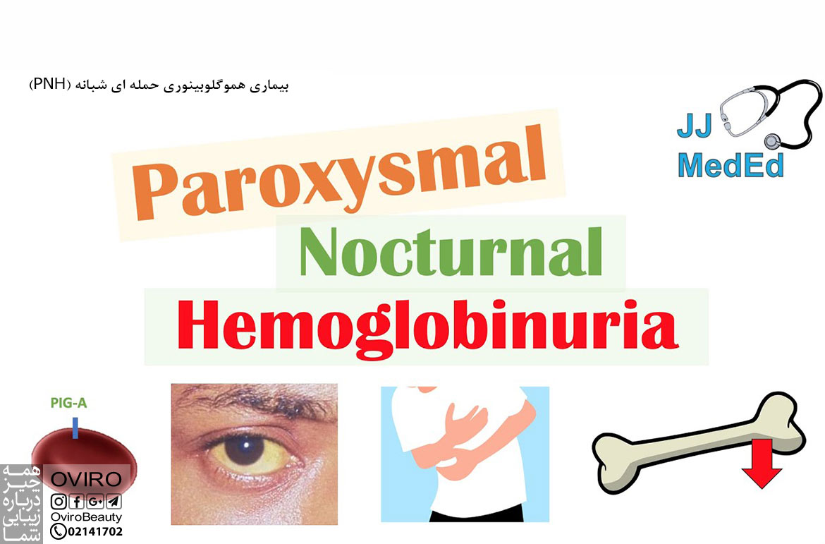 هموگلوبینوری حمله ای شبانه یا همولیز خون : علت - علائم - تشخیص و درمان بیماری PNH