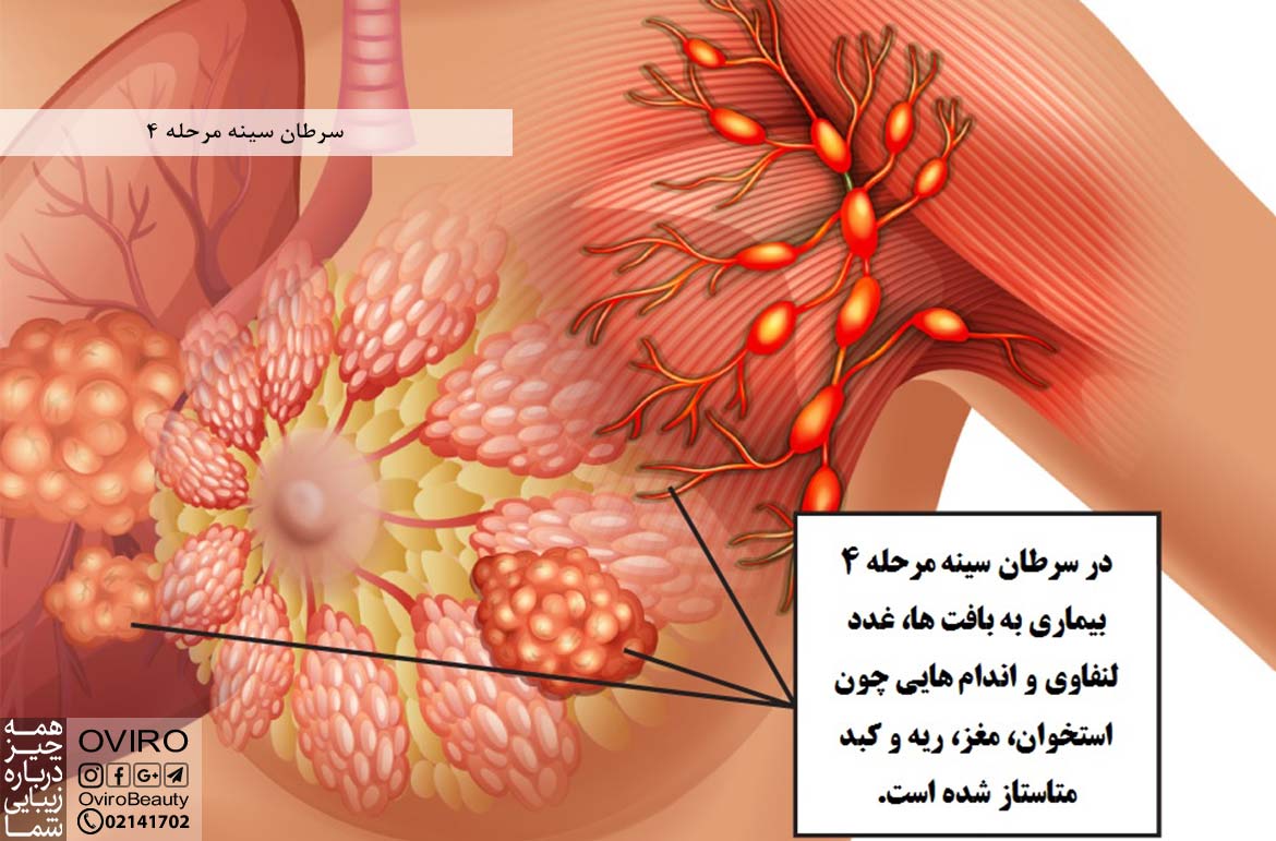 سرطان سينه مرحله ٤ : علائم متاستاز سرطان سینه به کبد - مغز - استخوان و ریه