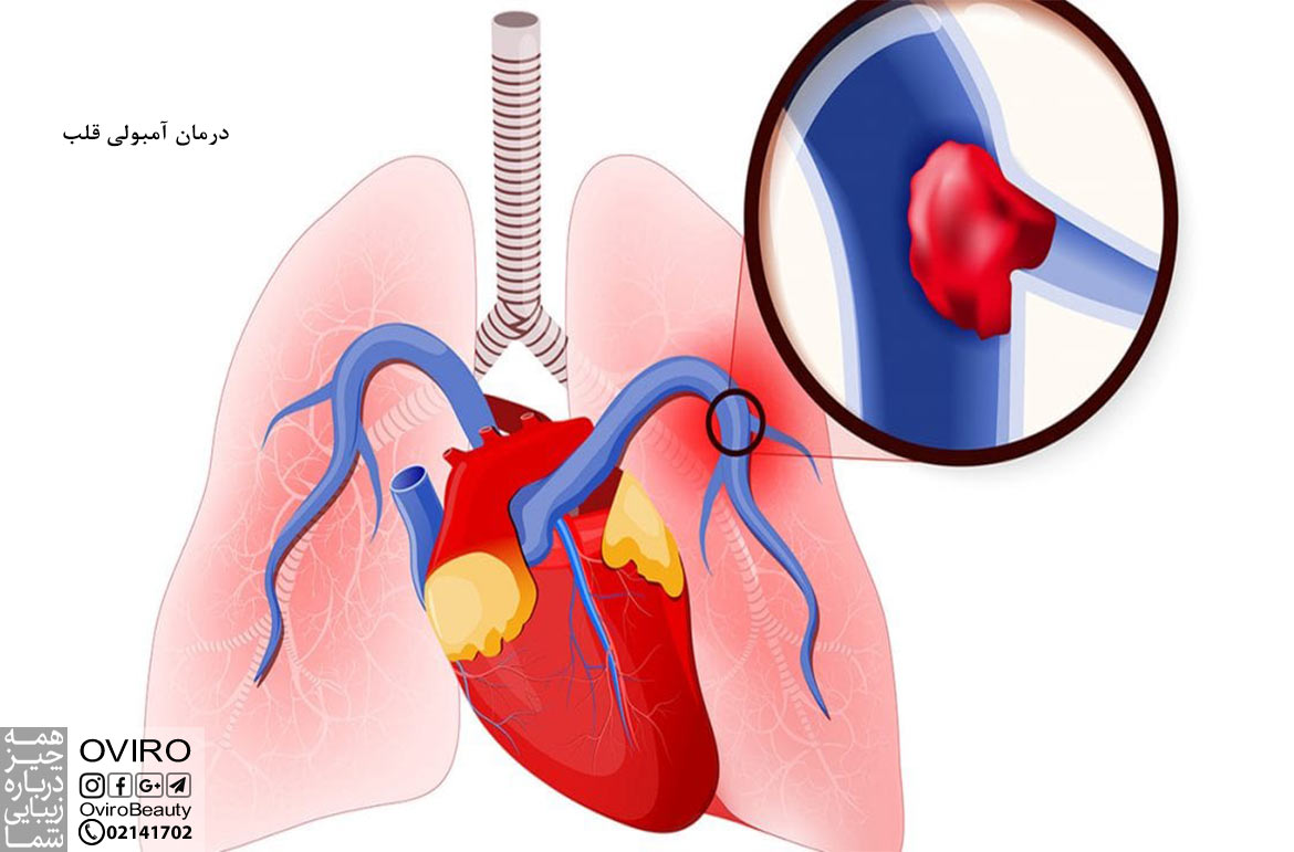 درمان آمبولی قلب - علائم - علت - عوامل خطر - نحوه تشخیص و پیشگیری