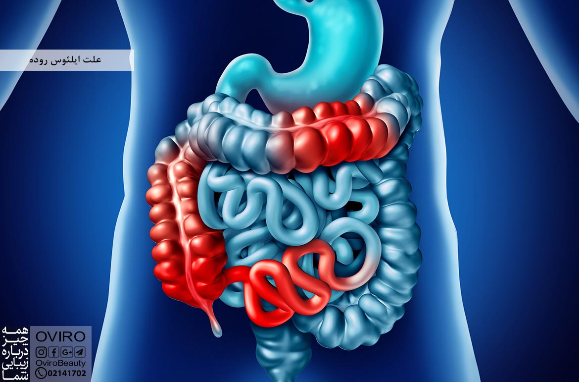 علت ایلئوس روده + علائم - انواع - تشخیص - درمان - عوارض | انسداد روده بعد از عمل