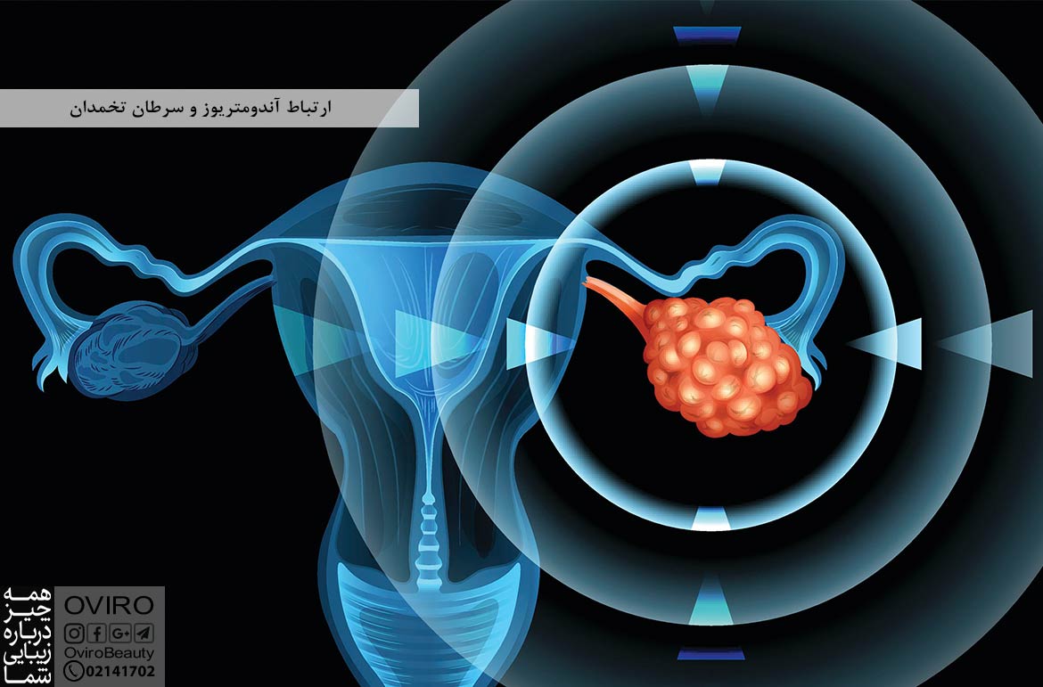 ارتباط آندومتریوز و سرطان تخمدان : ایا اندومتریوز باعث سرطان میشود