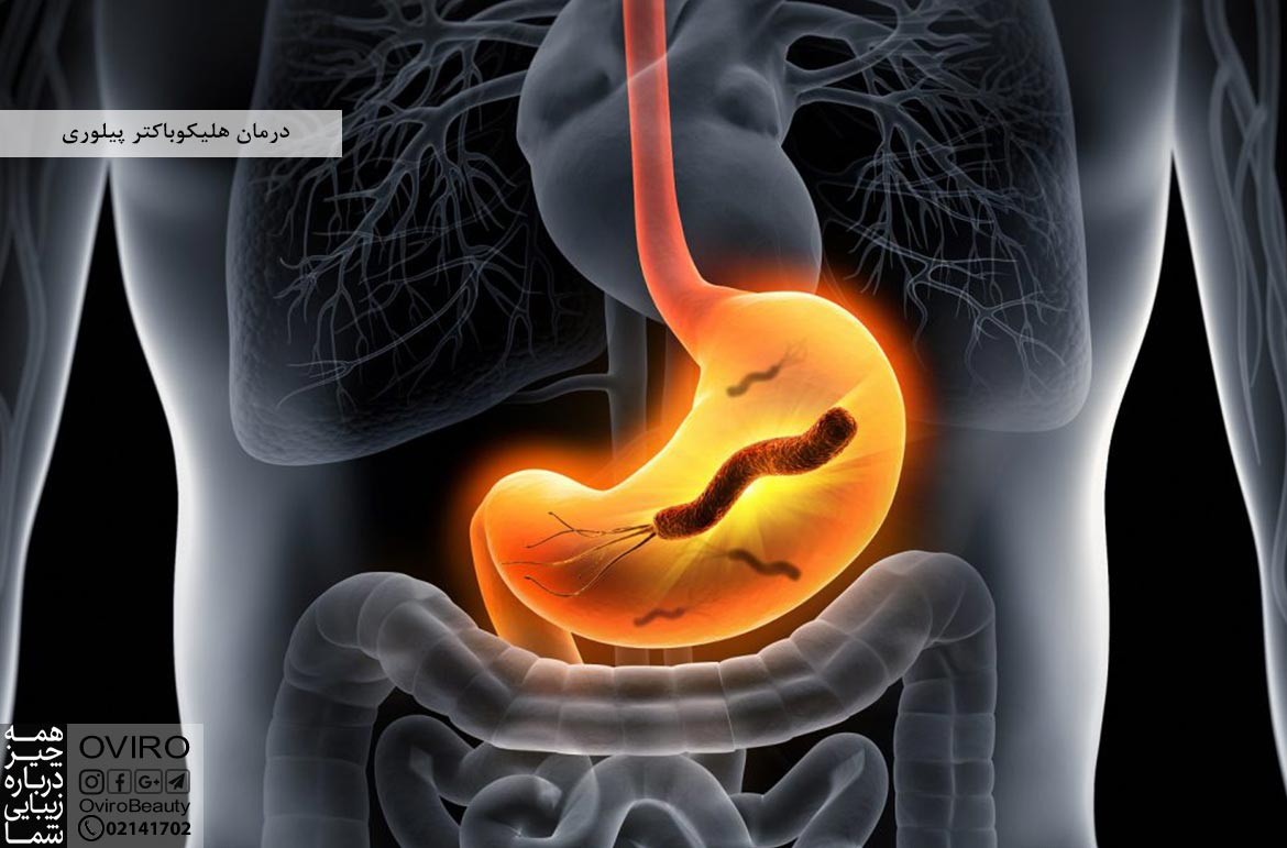 درمان هلیکوباکتر پیلوری : علائم - علت - آزمایش های تشخیصی - پیشگیری | زخم معده