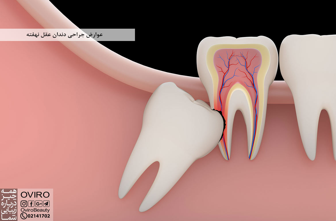 عوارض جراحی دندان عقل نهفته : علت و علائم نهفته بودن دندان عقل - کشیدن آن