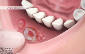 درمان تاول خونی دهان : علائم - علت - پیشگیری | تاول خونی داخل دهان نشانه چیست