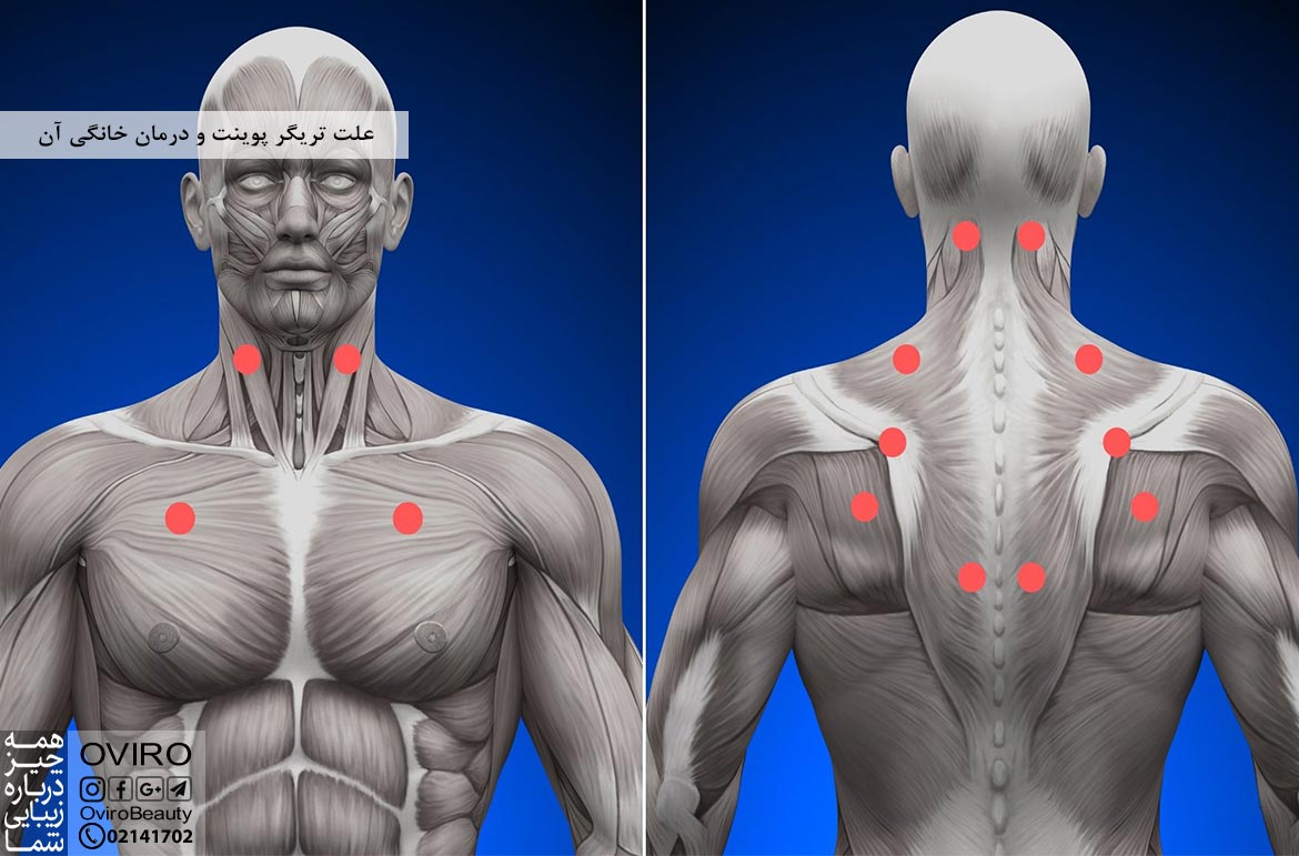 علت تریگر پوینت و درمان خانگی آن : علائم - پیشگیری - درمان پزشکی | نقاط ماشه ای