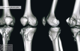 علائم شکستگی پلاتوی تیبیا : علت - درمان | سندرم کمپارتمان چیست