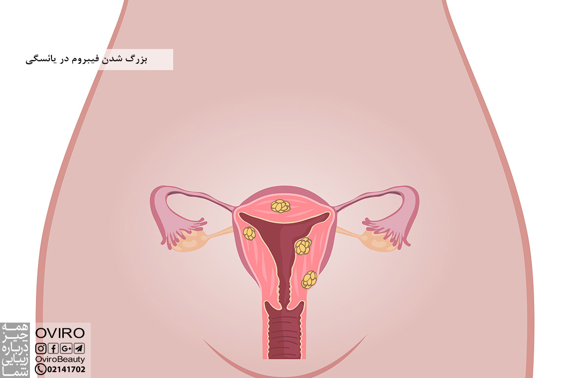 بزرگ شدن فیبروم در یائسگی : علائم - روش های درمان - سوالات متداول