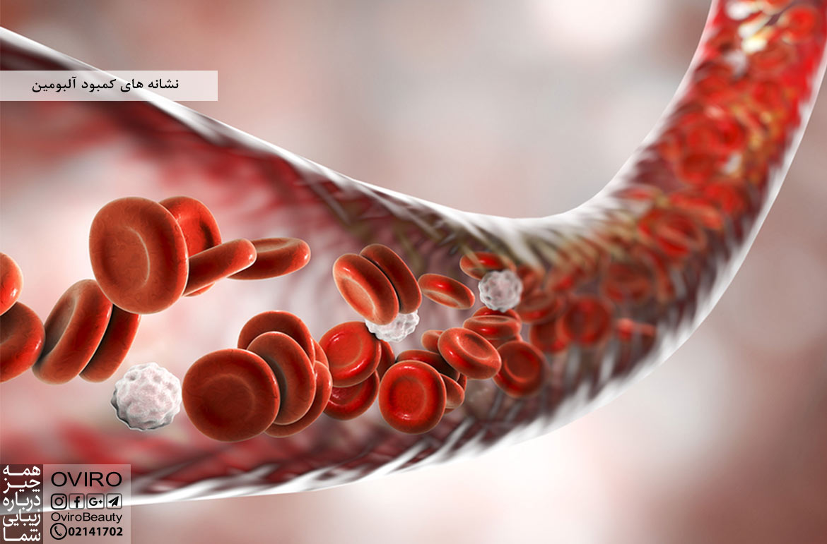 نشانه های کمبود آلبومین (هیپوآلبومینمی) : علت - درمان - عوارض - منابع غذایی